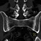 Sacroileitis, Crohn's disease: CT - Computed tomography
